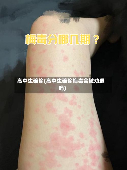 高中生确诊(高中生确诊梅毒会被劝退吗)