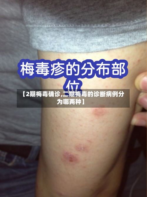 【2期梅毒确诊,二期梅毒的诊断病例分为哪两种】