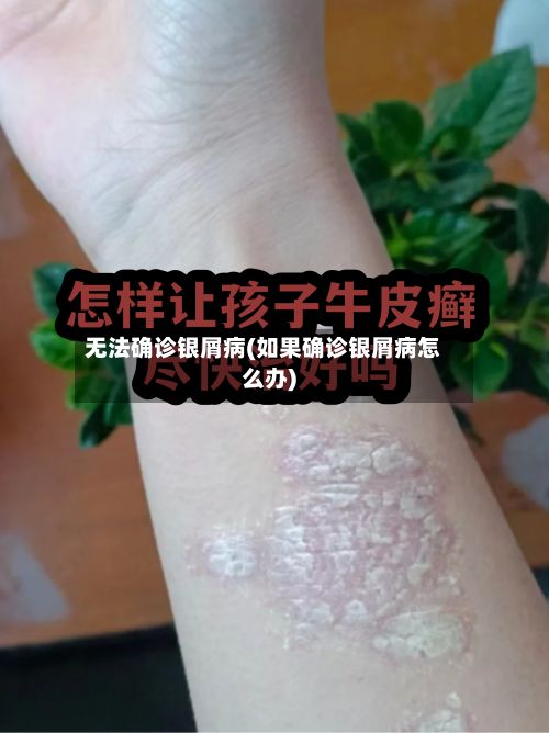 无法确诊银屑病(如果确诊银屑病怎么办)-第2张图片