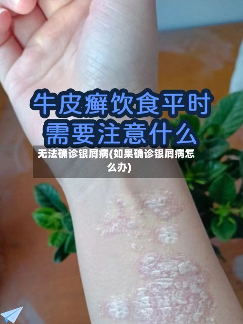 无法确诊银屑病(如果确诊银屑病怎么办)-第3张图片