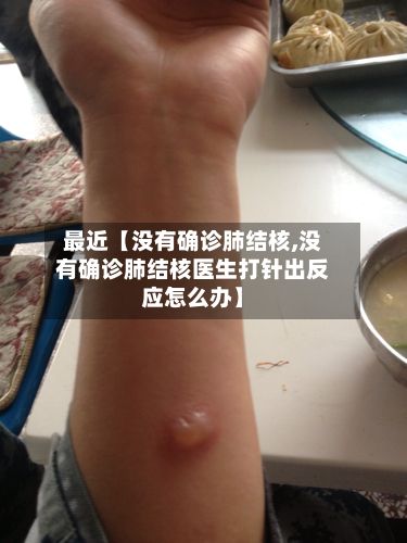 最近【没有确诊肺结核,没有确诊肺结核医生打针出反应怎么办】-第2张图片